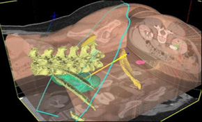 Planned puncture path mapped to 3D volumes