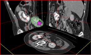 Kidney and cavities in delayed phase